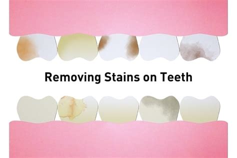 Common Causes Of Stains On Teeth And How To Treat Them The Dental Studio