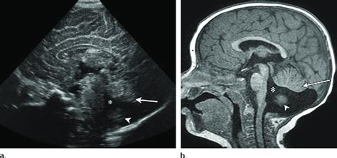 Dandy Walker Spectrum Malformation Of Moderate Severity In A Girl With Download Scientific