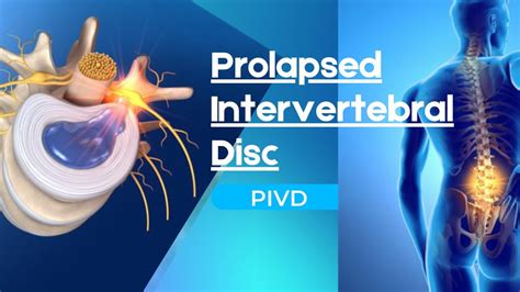 Prolapsed Intervertebral Disc PIVD Introduction YouTube