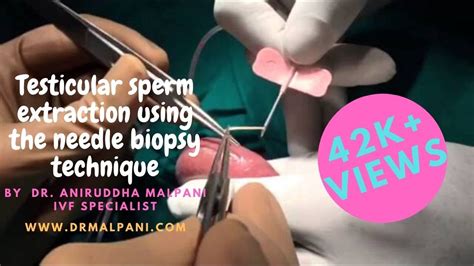 Tese Icsi Testicular Sperm Extraction Using The Needle Biopsy