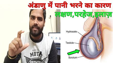 अंडकोष में पानी दर्द सूजन बडे होने का कारण व इलाज़ Hydrocele