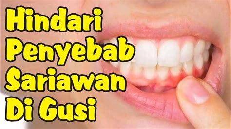 Penyebab Sariawan Di Gusi Yang Harus Dihindari YouTube