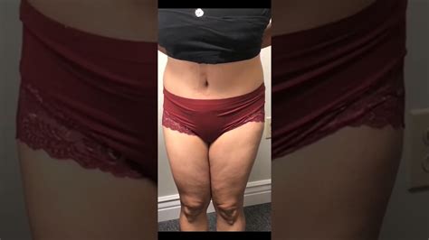 2 Weeks After A Natural Tummy Tuck By Dr Gabriel Patino 08 27 19 Youtube