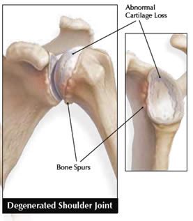 shoulder joint arthritis | Family Health Chiropractic