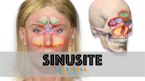 Sinusite - Resumo, o que é, sintomas, tratamento, prevenção, cura