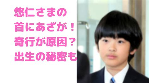 悠仁さまの首のあざは奇行が原因？画像や出生の秘密、誰の子かについても D Media