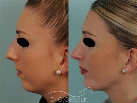 Rhinoplastie Avant Apr S Photos Et Exemples De Nez Refaits