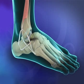 Ankle Ligament Reconstruction Fort Worth | Ankle Ligament Tear Weatherford TX