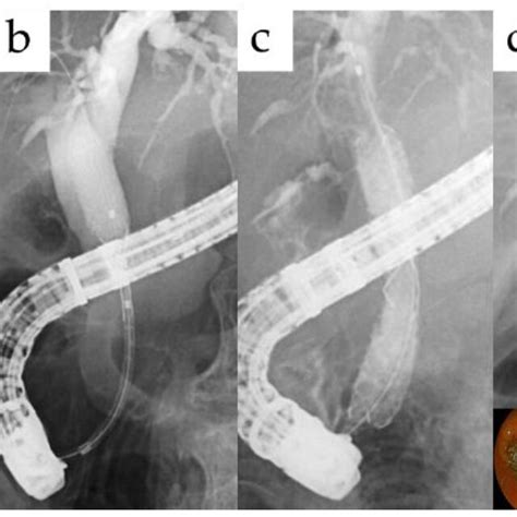 Stent Placement Method Following Insertion Of The Guidewire Via The