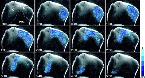 Nitric Oxide Modulates Spreading Depolarization Threshold In The Human