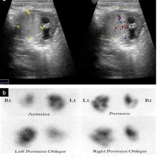 A US image of the left kidney shows an echogenic renal mass in the left... | Download Scientific ...