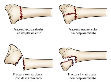 Fracturas Distales Del Radio Mu Eca Quebrada Distal Radius Fractures