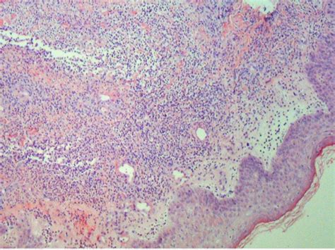 Punch Biopsy Of A Skin Lesion Showing Neutrophilic Infiltration In The