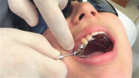 Presenting The Herbst Appliance Part 2 Tom Nasiopoulos Specialist Orthodontist Youtube