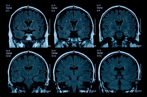 Cortical Thinning in Specific Brain Regions May Be Associated With Migraine - Neurology Advisor