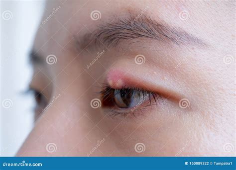 Close Up Of Asian Young Woman With Brown Eye With Stye Infection