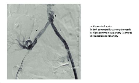 Post Deployment Angiogram Image Shows New Antegrade Flow In The Right Download Scientific