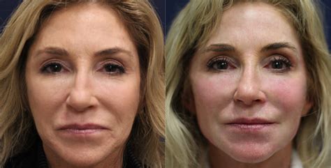 Droopy Face Los Angeles Facial Rejuvenation Beverly Hills