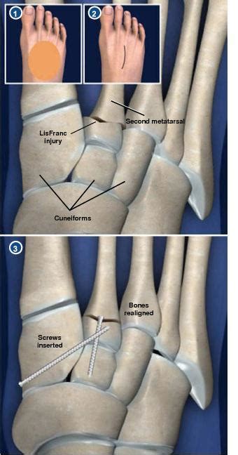 Fixation For Lisfranc Injury Sarasota Fl Schofield Hand And Bright Orthopaedics