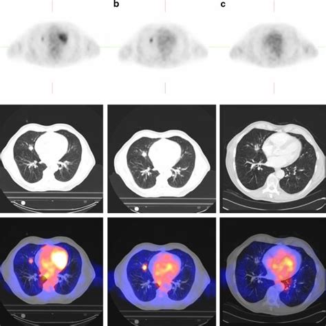 Sequential Axial Pet Upper Row Ct Middle Row And Fused Pet Ct