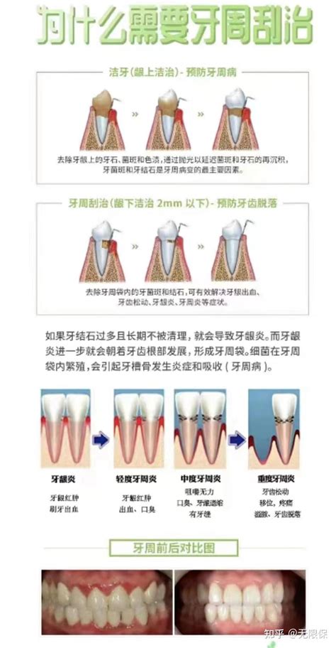 牙龈出血是什么疾病的症状？ 知乎