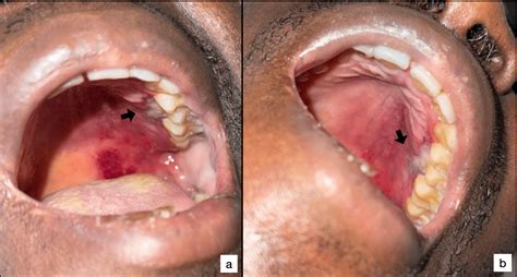 Palatal Petechiae Causes Symptoms And Treatment Options Bloomsies