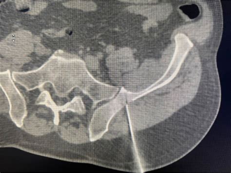 Computed Tomography Ct Showing Puncture Site In Osteoblastic Lesion