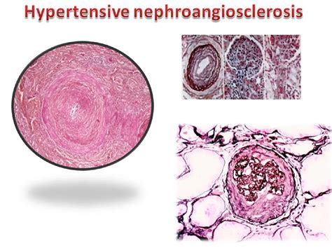 Hypertensive Nephrosclerosis Archives Pathway Medicine