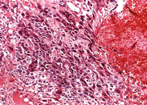 Germ cell, stromal, and other ovarian tumors | Oncohema Key