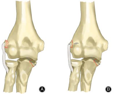 Repair Versus Nonrepair Of Lateral Ulnar Collateral Ligament In Elbow