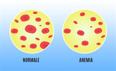 Anemia Med4care