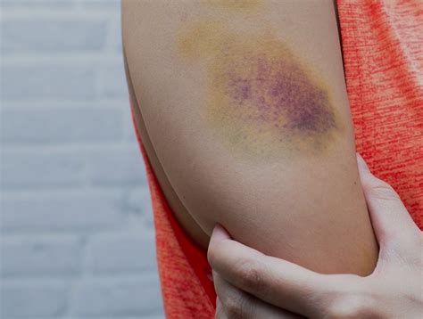 What Are The Types Of Bruises