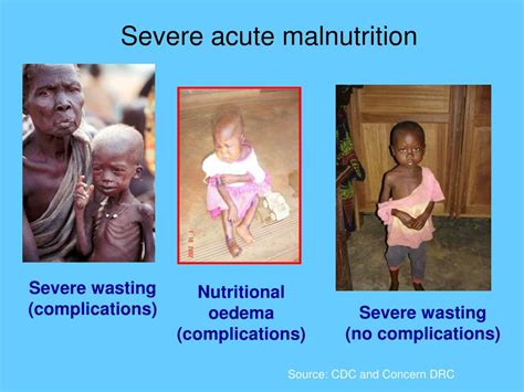 Ppt Cost Effectiveness Of Community Based Management Of Severe Acute