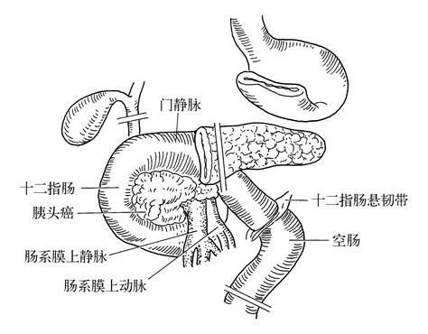 7胰腺癌手术包括哪些术式 外科学 医学