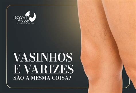 Qual a diferença entre vasinhos e varizes