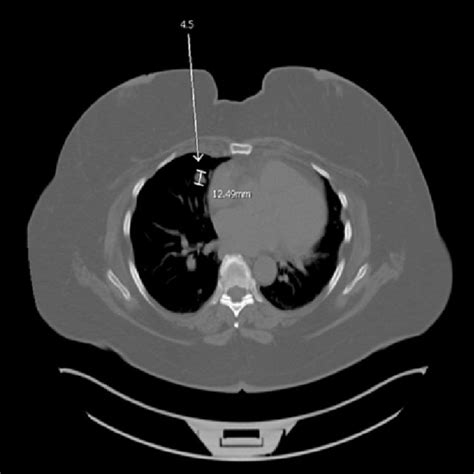 Computed Tomography Chest Showing Lung Nodule In The Medial Right