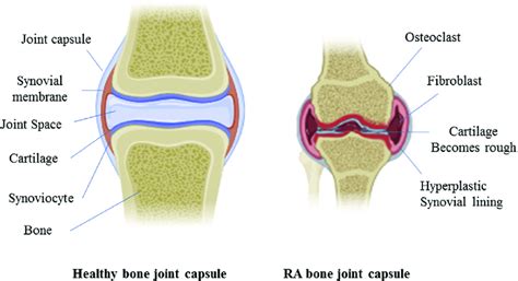 Bone Joint Differentiation Of Normal And Rheumatoid Arthritis The Download Scientific Diagram