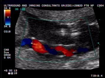 Ultrasound Of Single Umbilical Artery