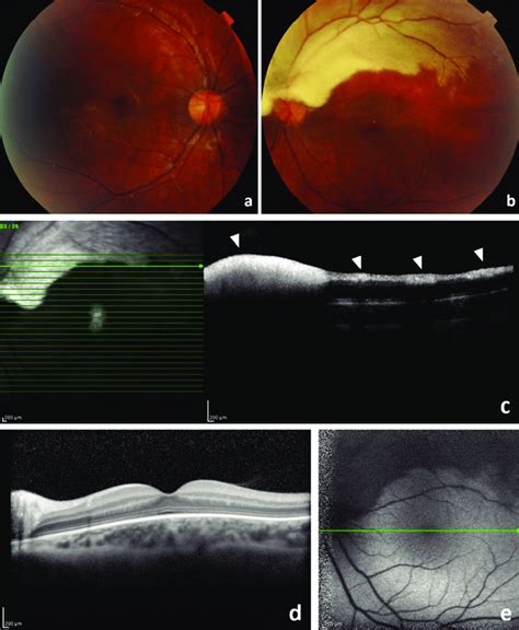 Color Fundus Photographs Spectral Domain Optical Coherence Tomography