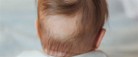 7 Reasons for Baby Hair Loss and What You Can Do About It - Mama's ...