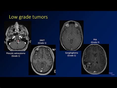 Mri Brain Tumor Glioblastoma