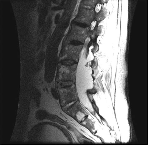 MRI Spine Ankylosing Spondylitis