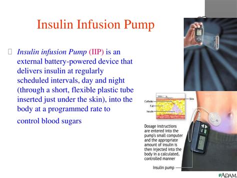 Ppt Insulin Infusion Pump Powerpoint Presentation Free Download Id