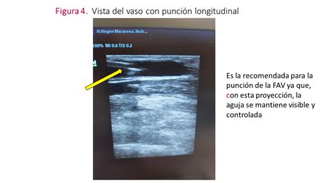 Punci N Ecoguiada Del Acceso Vascular Para Hemodi Lisis Nefrolog A Al D A