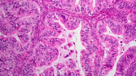 Types Of Ovarian Tumors Ovarian Cancer Johns Hopkins Pathology