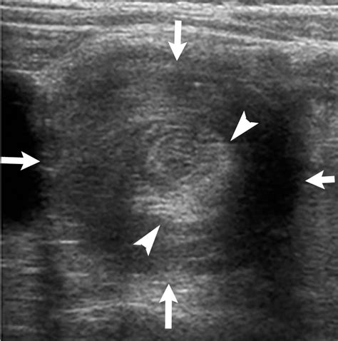 Screaming fits: Intussusception | Radiology Key