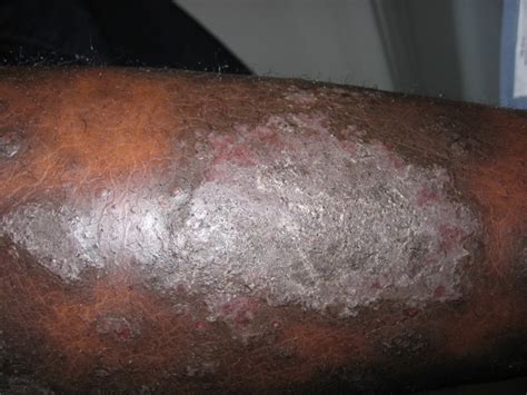 psoriasis-black skin- image source dermatologytimes - Dr. Darams