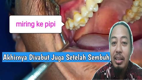 Video Paling Dinanti Proses Pencabutan Geraham Bungsu Atas Yang