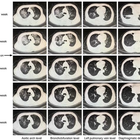 The Computed Tomography Findings Of One Patient No Before Week