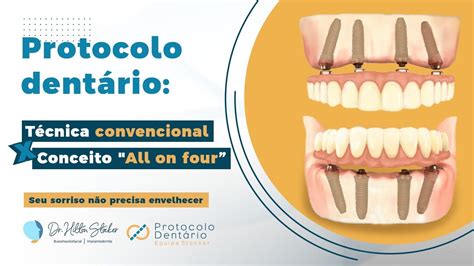 Protocolo Dentário Técnica Convencional x All on Four YouTube